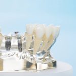 Rodzaje implantów dentystycznych