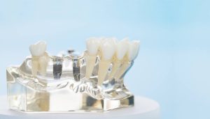 Rodzaje implantów dentystycznych