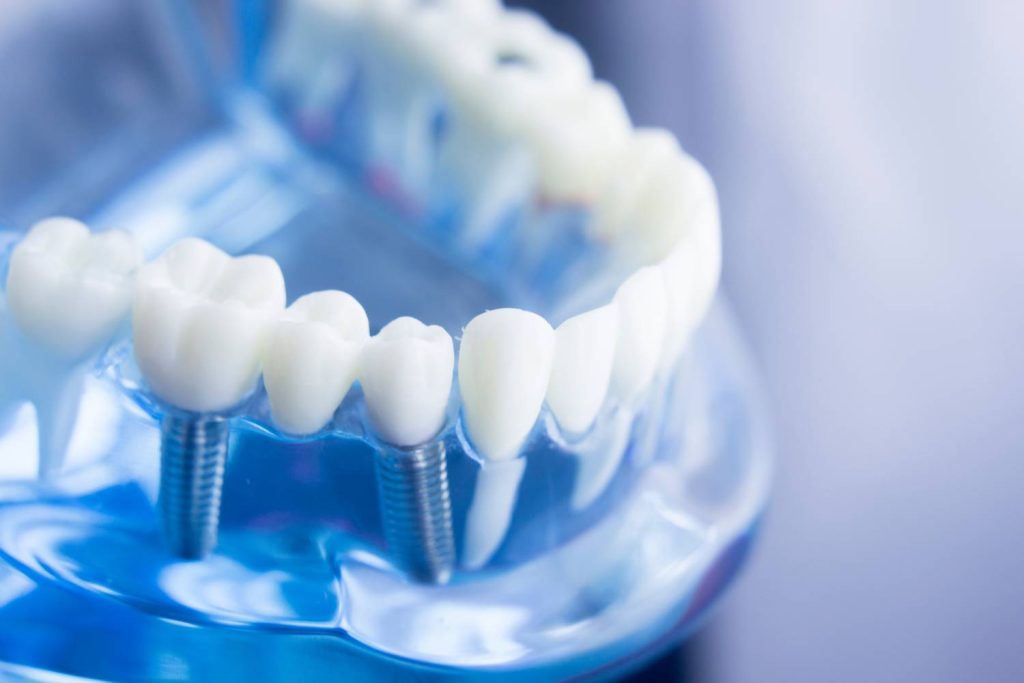 Szczecin i implanty zębów